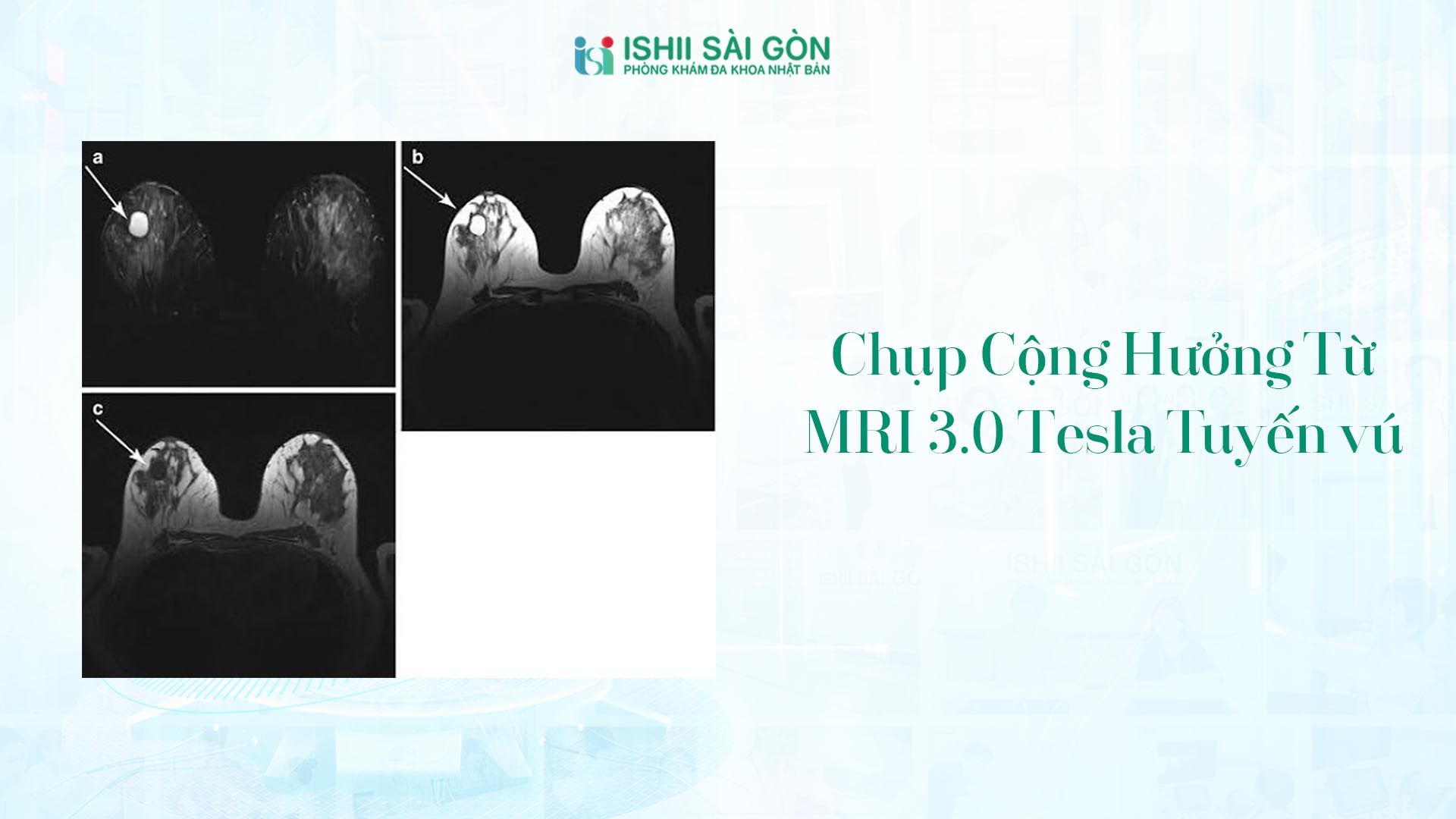 Tại sao bạn cần chụp MRI tuyến vú định kì?