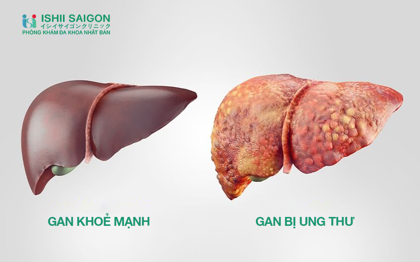 Ung thư gan: Những ai nên thực hiện tầm soát sớm?