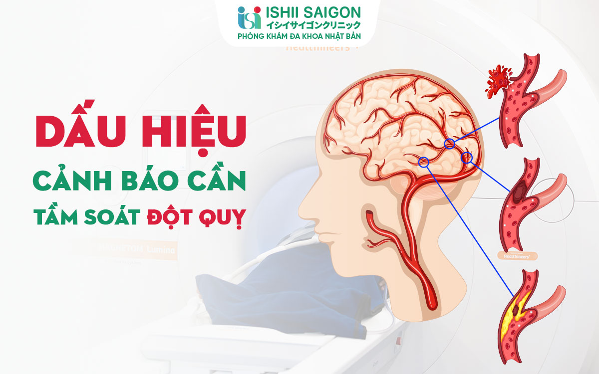 Những dấu hiệu cảnh báo cần tầm soát đột quỵ và chức năng tim mạch