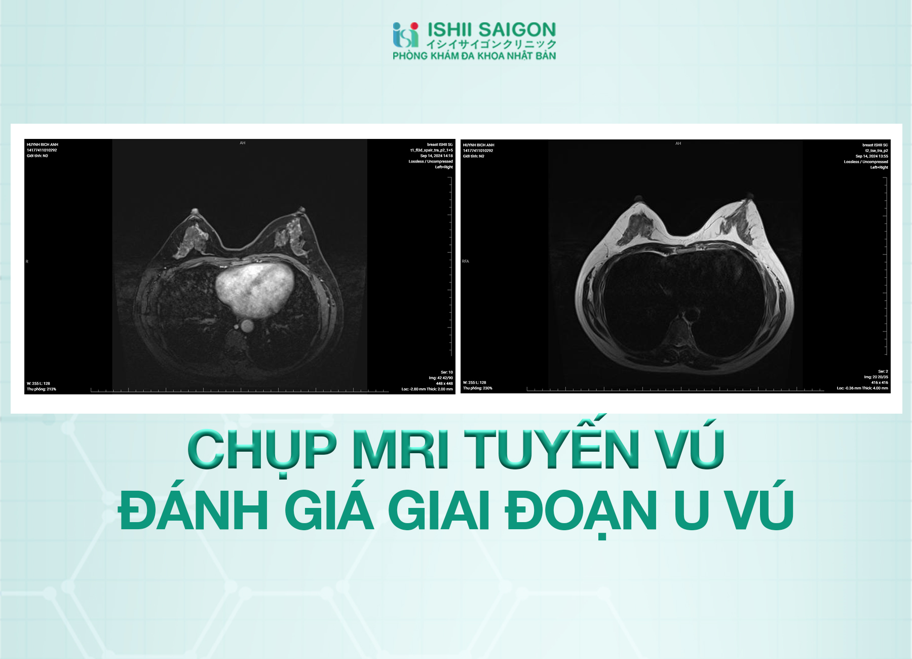 Đánh giá giai đoạn ung thư vú bằng MRI